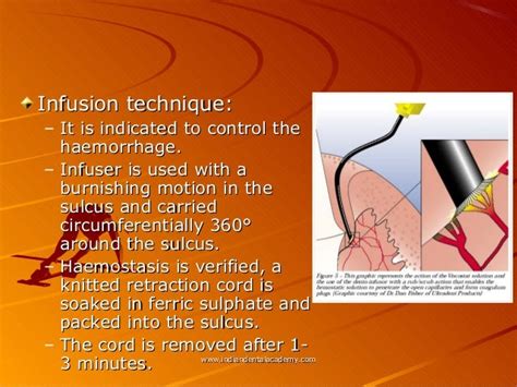 Gingival Retraction Pptcosmetic Dentistry Courses