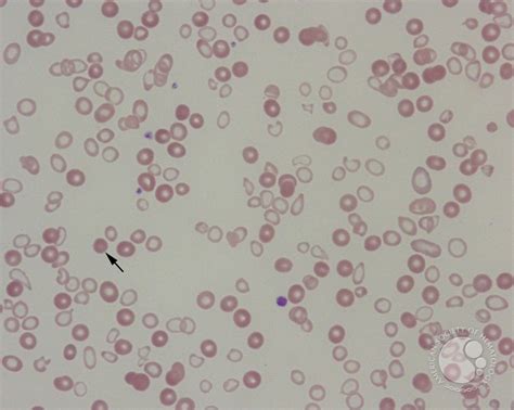 RBC morphology in thalassemia - 1.