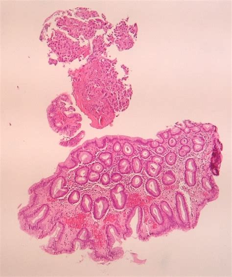 Pathology Outlines Choriocarcinoma