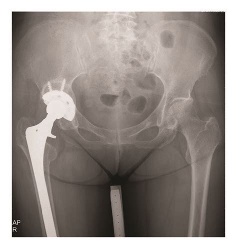 A 69 Year Old Female Patient With Aseptic Loosening Of Right Bipolar Download Scientific