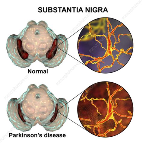 PHL3 Pharmacology Of Parkinson S Disease Flashcards Quizlet