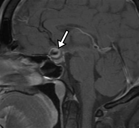 Intrasellar Aneurysm Identified By A Flow Void Arrow Due To The High