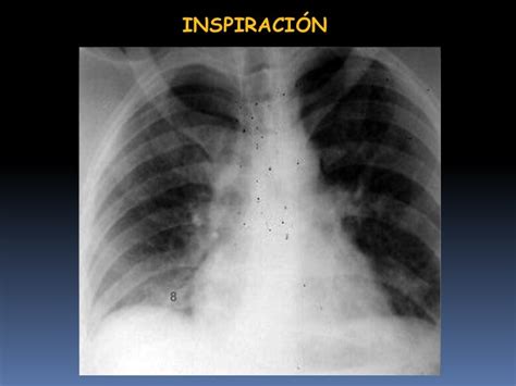 Imagenología Del Tórax Clase