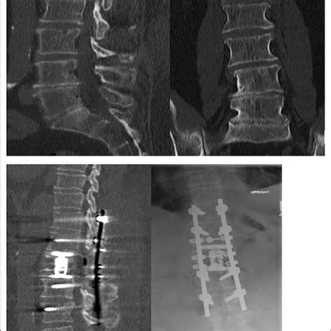 Patient Y with L1 burst fracture who underwent lateral L1 corpectomy ...