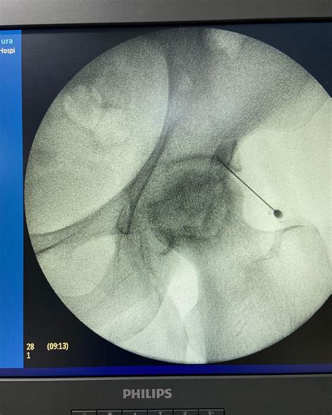 AVASCULAR NECROSIS HIP -pain due... - Pain management clinic