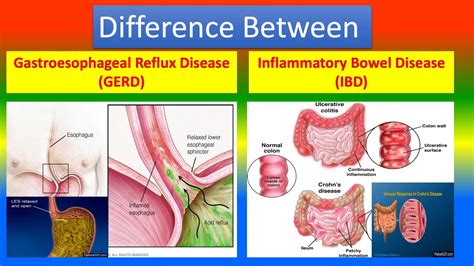 Difference Between Gastroesophageal Reflux Disease GERD And