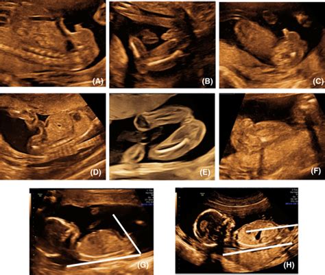 Fetal Sex Determination During Ultrasonography Should We Focus On How Rather Than Why Størup