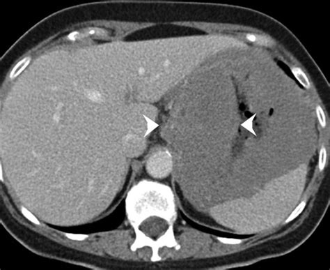 Primary Gastrointestinal Lymphoma Spectrum Of Imaging Findings With Pathologic Correlation