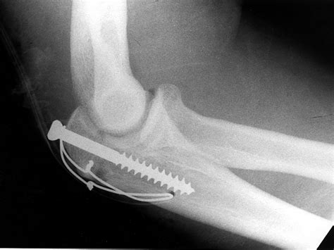 Olecranon Fracture Tension Band Wiring