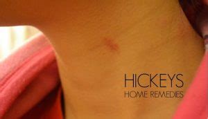 How to Get Rid of Hickeys Quickly (13 Best Ways)
