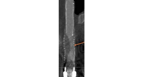 Fall des Monats Stenting einer Stenose bei einem Patienten mit LVAD ǀ