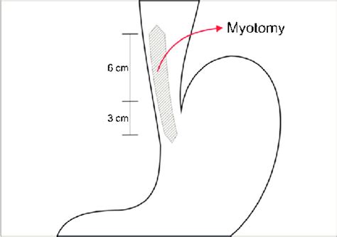 myotomy   anterior wall   esophagus   stomach exposing