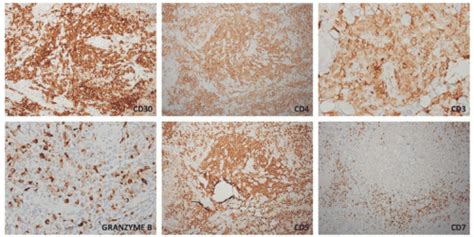 Cutaneous Hematolymphoid Proliferations Plastic Surgery Key