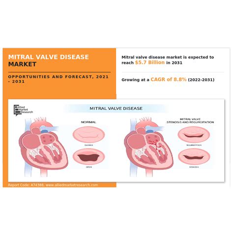 The Mitral Valve Regurgitation Segment Dominated The Mitral Valve