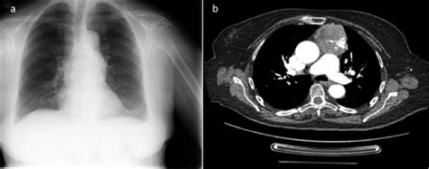 Chest X Ray And Computed Tomography Scan A Mediastinal Widening B