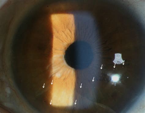 Slit Lamp Biomicroscopic Findings In Our Uveitis Patient The Slit Lamp