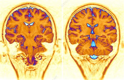 Normal Brain Mri Scan Stock Image C Science Photo Library