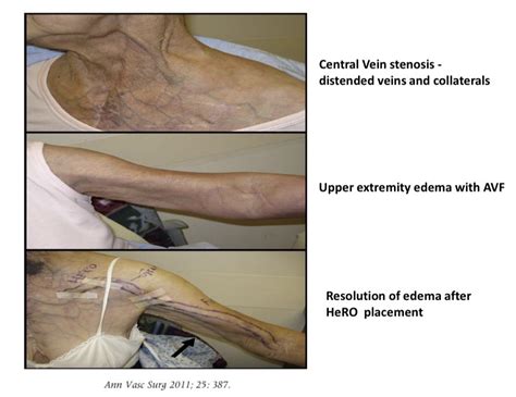 Hero Catheter Placement