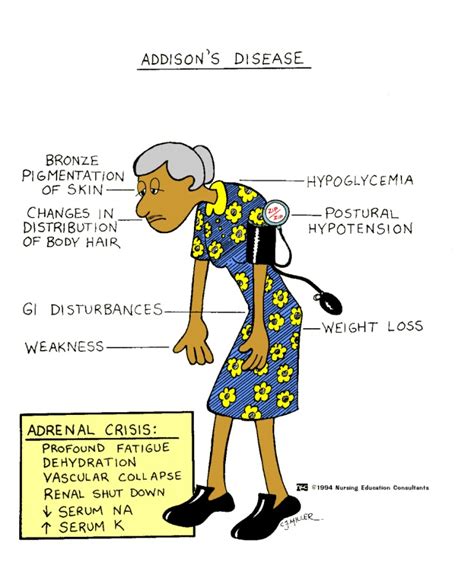 All For Nursing Ms Addison S Disease Vs Cushing S Disease