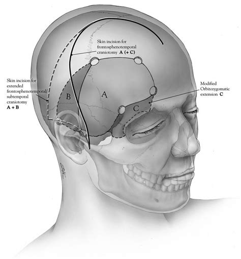 Right Pterional Craniotomy For A1 Segment Pseudoaneurysm Cns Org