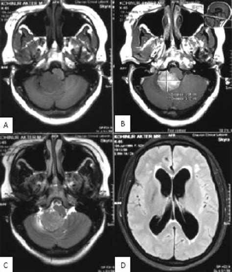 Axial Magnetic Resonance Mr Image A T1 Weighted Image Showing A