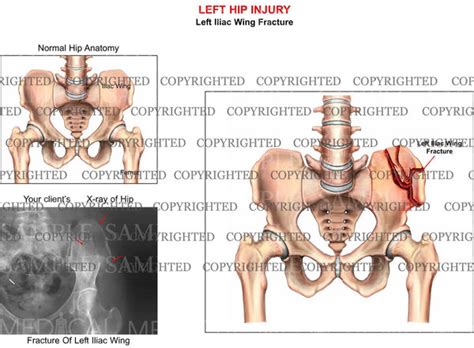 Left Hip Iliac Wing Fracture — Medical Art Works