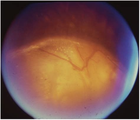 Fundus Photograph Of Choroidal Coloboma I The Coloboma Extends Above