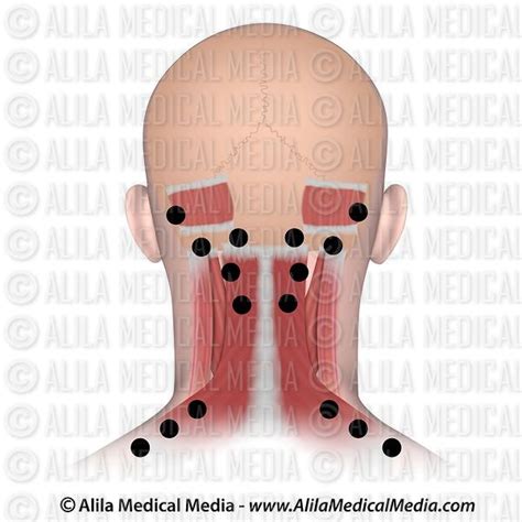 Alila Medical Media Pontos De Inje O De Botox Para O Tratamento Da