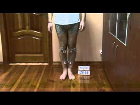 Bow legs (Hjulbent) correction treatment - Sweden patient experience ...