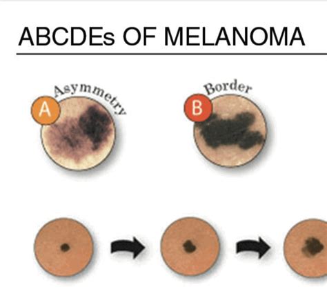 Know Your Moles - ABCDE - IMPACT Melanoma