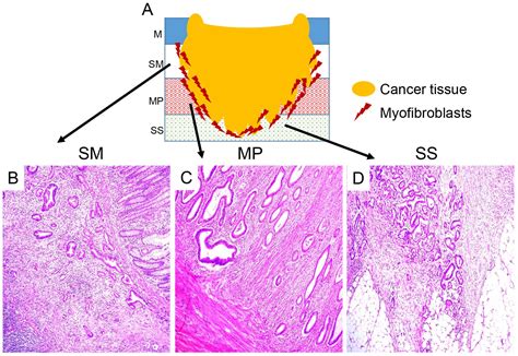 Myofibroblasts Of The Muscle Layer Stimulate The Malignant Potential Of