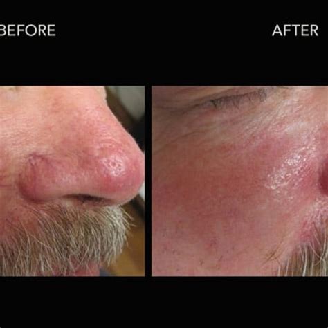 Rosacea Treatments In Kelowna By Dermmedica