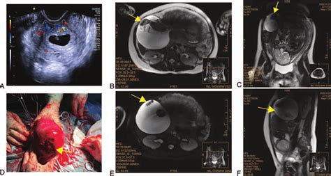 Ultrasound Magnetic Resonance Imaging And Surgical Image Of The