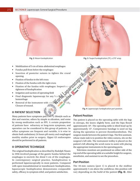 Laparoscopic Fundoplication at World Laparoscopy Hospital | PDF