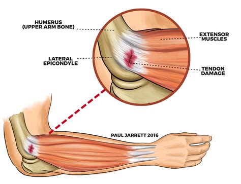 Lateral Epicondylitis - Camberwell Osteopathic Clinic