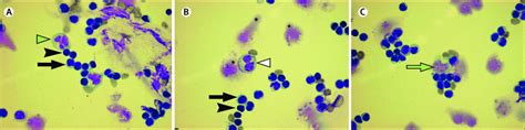 Figure Csf Cytomorphological Image Of Large Monocytes With Variable