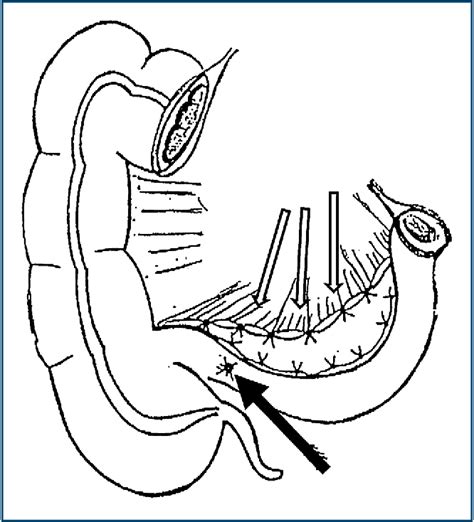 Figure 1 From Distal Ileal Necrosis Right Ileo Colic Intussuscepted Anastomosis As An