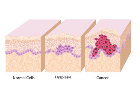 Displasia Anal Lo Que Debe Saber Memorial Sloan Kettering Cancer Center