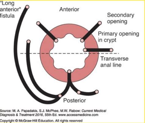 Hemorroida Fissura Anal E Abscessos Perianal Quizlet