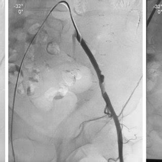 limb angiogram showing stenting  left external iliac artery