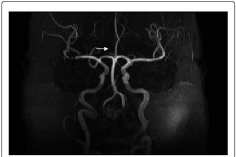 MR Angiogram Of The Head And Neck MRA Demonstrates Stenosis Of M1