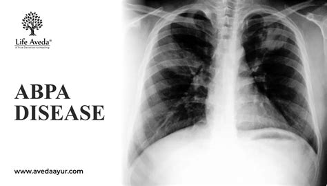 Main Cause Behind the Occurrence of ABPA Disease - Aveda Ayur