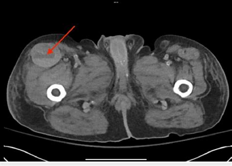 A Pelvic Ct Scan Without Contrast Detected A Sizable Fluid Collection