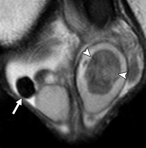 Mr Imaging Of Scrotal Tumors And Pseudotumors Radiographics