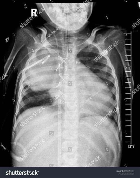 Lung Cancer Chest X Ray