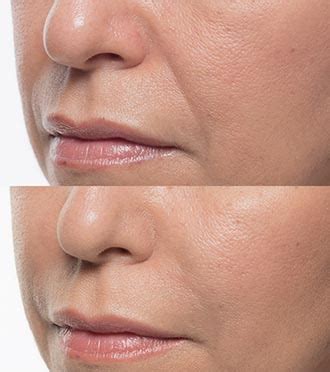 Bellafill Cosmetic Dermal Filler In Gainesville Fl