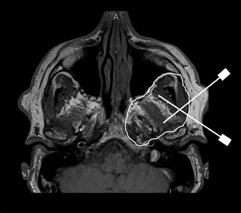 Image Guided Head And Neck Biopsies From Superficial To Deep