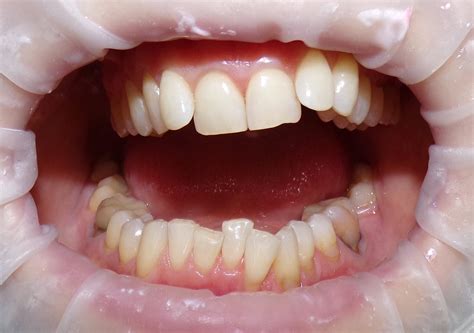 Неправильный прикус и гигиена зубов | Стволыгин