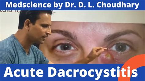 Acute Dacryocystitis Youtube