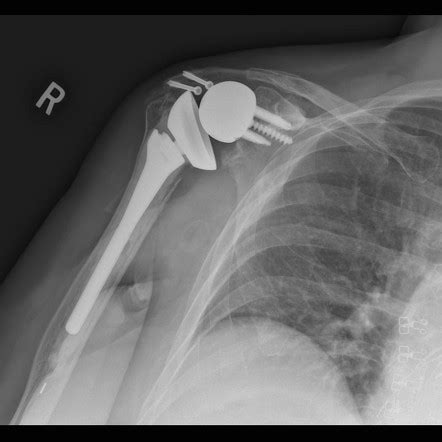 Shoulder Arthroplasty Overview Radiology Reference Article